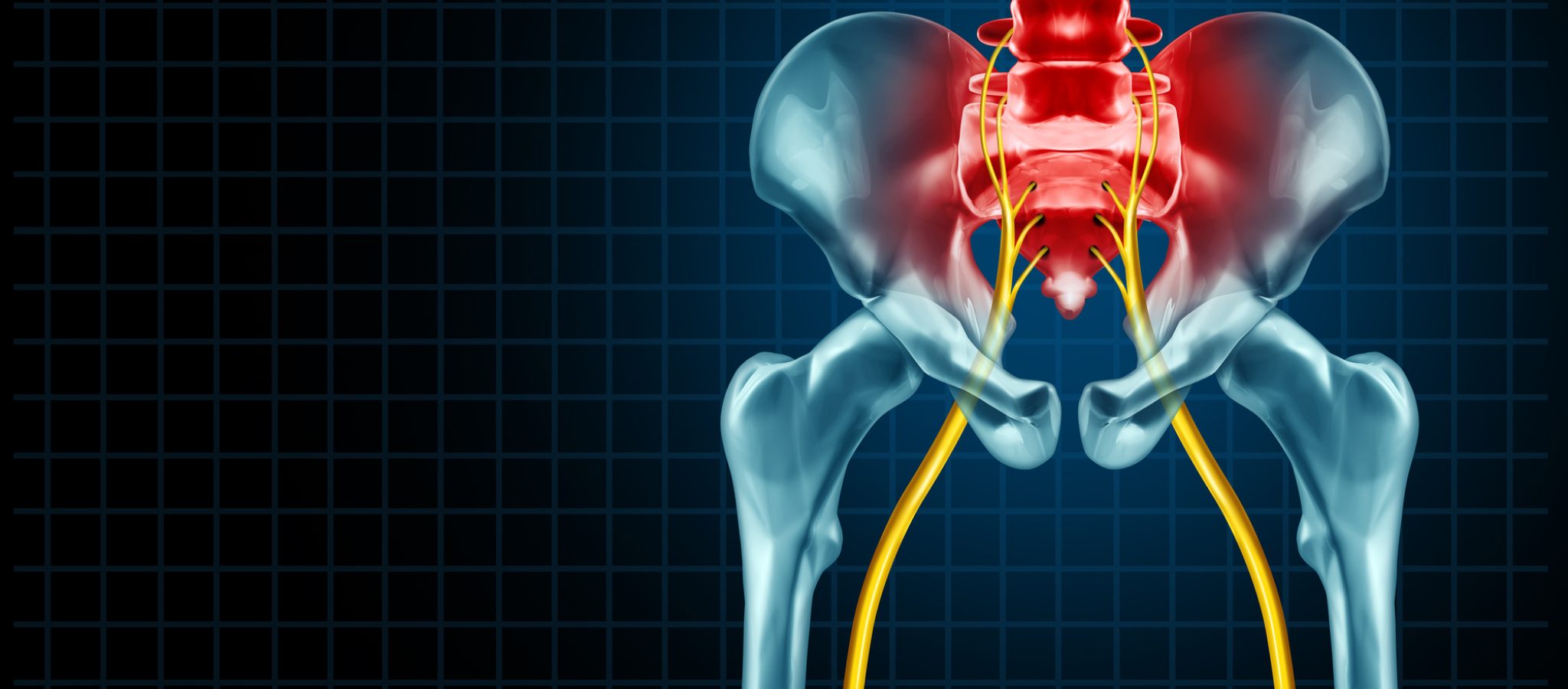 Painful sciatica nerve symptom and pain diagnosis as a medical concept for a disease causing physical problems with 3D illustration elements.
